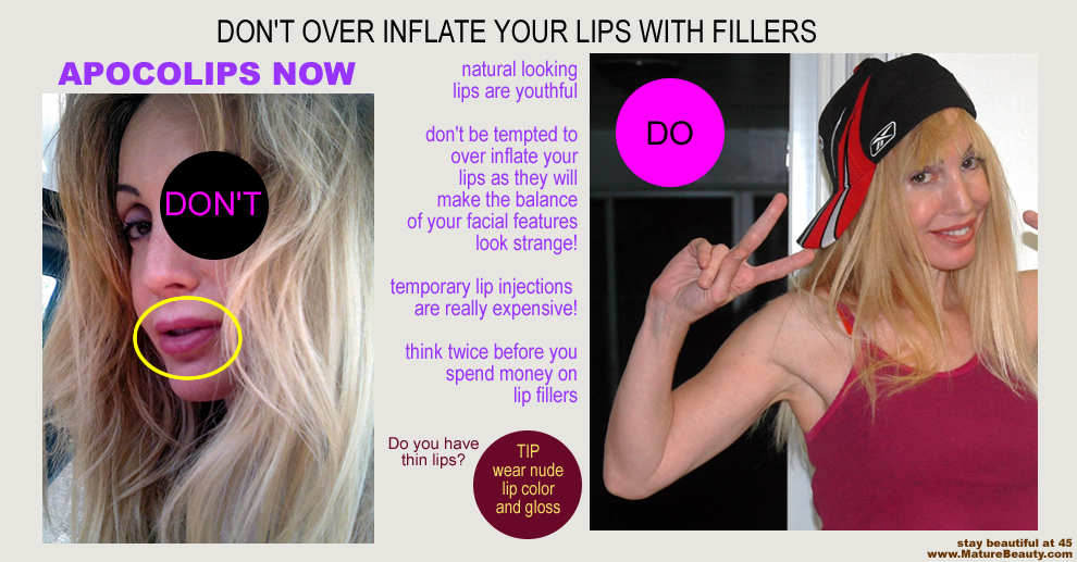 If you repeatedly get lip injections of collagen, juvederm or restylane you may become lip dysmorphic, poor from the cost of the injections, and ugly!