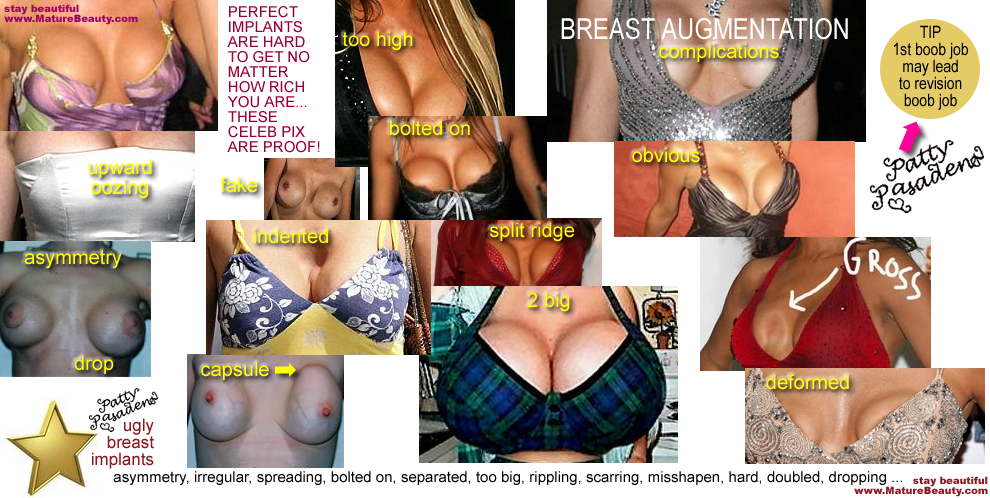 ugly breast implants, breast implant surgery, boob jobs, awful plastic surgery, horrible breast implants, breast implant complications, revision breast implants, breast implant horror, bad breast implants, awful boob jobs, celebrity breast implants